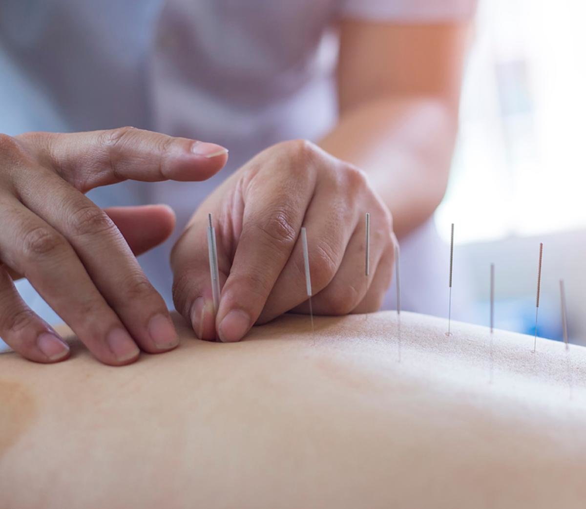 Dry Needling Method