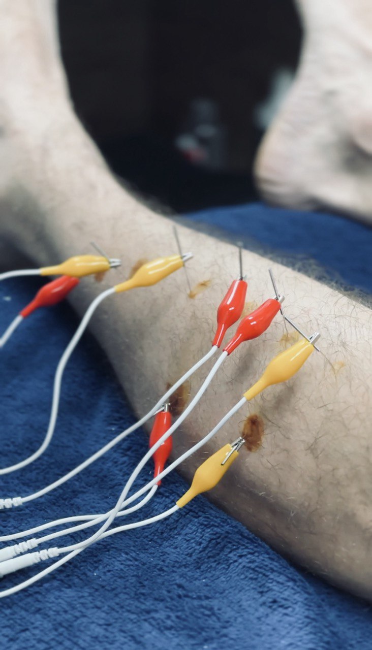Dry Needling Method with Electrical Stimulation